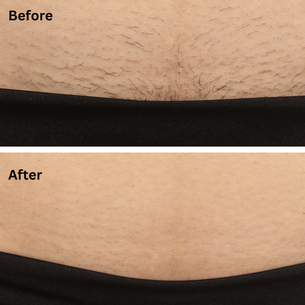 Sensilight™ Pro At-Home Hair Removal