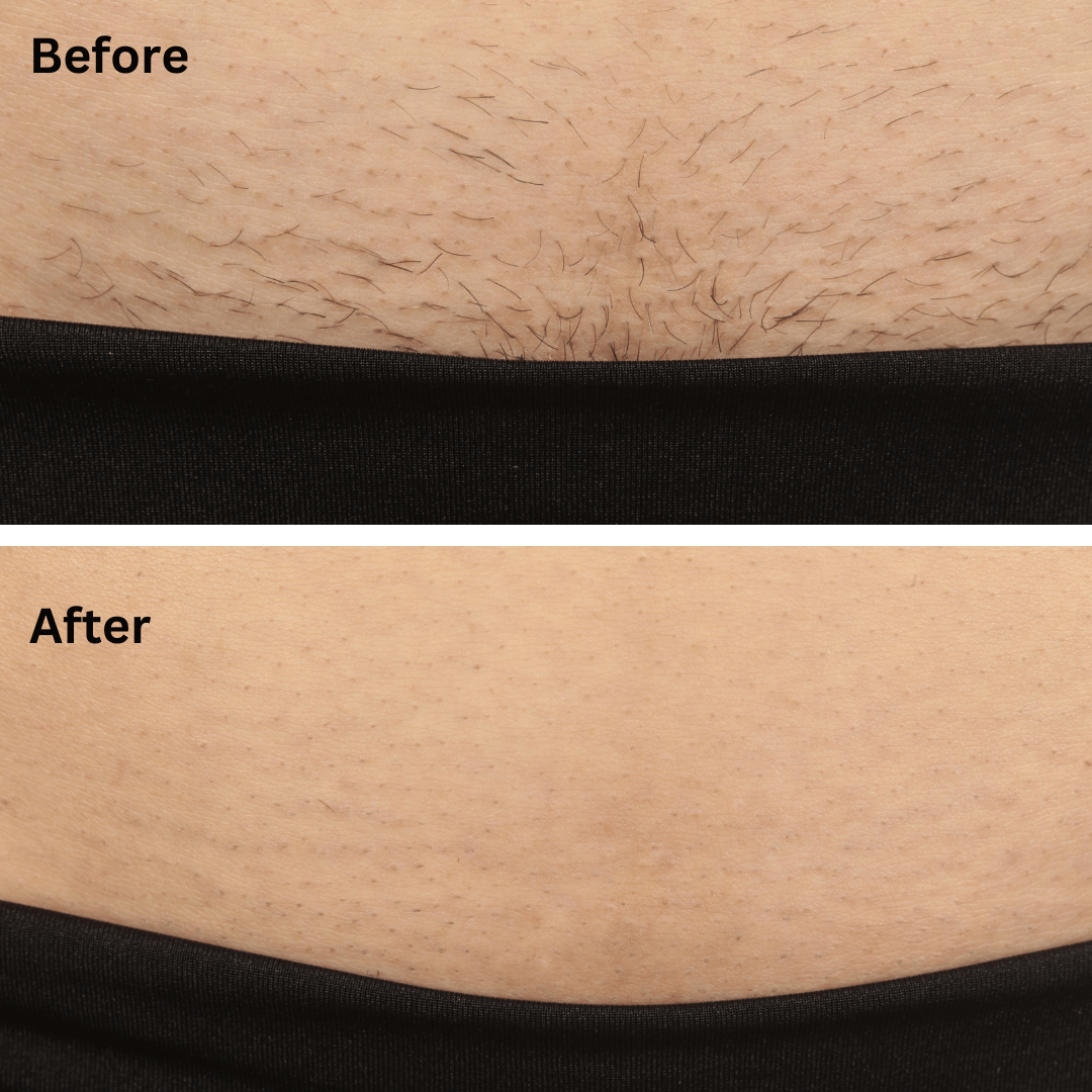 Sensilight™ Pro At-Home Hair Removal