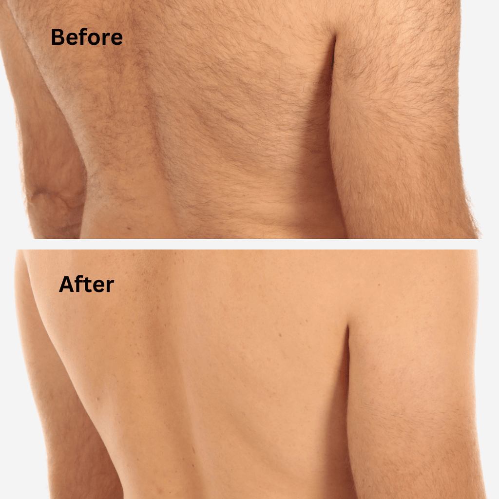 Sensilight™ Pro At-Home Hair Removal