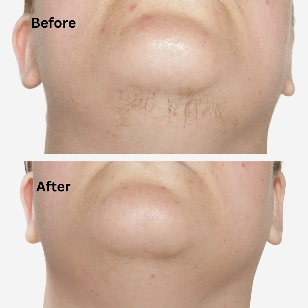 Sensilight™ Mini Smart Hair-Removal