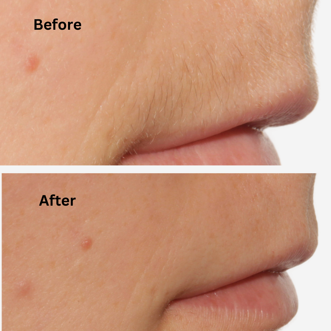 Sensilight™ Mini Smart Hair-Removal